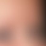 Differenzialdiagnose: Naevus flammeus asymmetrischer

Diagnose: Lachsfleck (symmetrischer Naevus ...