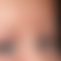 Differenzialdiagnose: Naevus flammeus asymmetrischer

Diagnose: Lachsfleck (symmetrischer Naevus ...