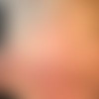 Anstrengungsurtikaria: 20 min. nach körperlicher Anstrengung auftretendes urtikarielles Exanthem....