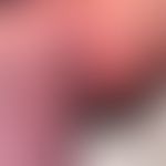 Anstrengungsurtikaria: 20 min. nach körperlicher Anstrengung auftretendes urtikarielles Exanthem....
