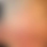 Urtikaria, cholinerge (Anstrengungsurtikaria): kleinerherdige Quaddebildung, initial mit follikul...
