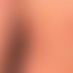 Anstrengungsurtikaria: etwa 20&nbsp; min. nach körperlicher Anstrengung auftretendes urtikarielle...