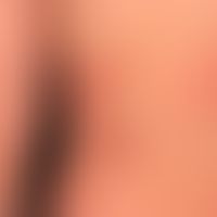 Anstrengungsurtikaria: etwa 20&nbsp; min. nach körperlicher Anstrengung auftretendes urtikarielle...