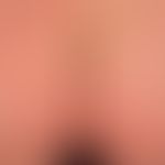 Anstrengungsurtikaria: etwa 20&nbsp; min. nach körperlicher Anstrengung auftretendes urtikarielle...