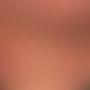 Lipome: kugelige weiche schmerzlose Geschwülste, keine Wachstumstendenz.
