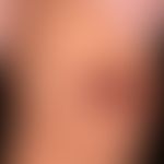 Hämangiom des Säuglings: deutlich rückgebildetes Hämagiom mit zentraler Ulzeration.
