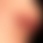Gemischtes (intra-/subkutanes) Hämangiom: bereits deutlich rückgebildetes, zentral ulzeriertes&nb...