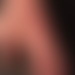 Dermatomyositis: "Dermatomyositishand" mit umschriebenen vaskulitischen "pränekrotischen" Arealen.
