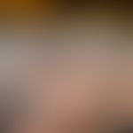TAGU-Syndrom mit flächiger sarkoider Infiltration im Tattoo-Areal.&nbsp;

Abb. entnommen aus:&nbs...