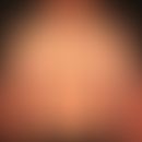 Anstrengungsurtikaria: etwa 20&nbsp; min. nach körperlicher Anstrengung auftretendes urtikarielle...