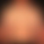 Anstrengungsurtikaria: etwa 20&nbsp; min. nach körperlicher Anstrengung auftretendes urtikarielle...