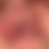 Gingivostomatitis herpetica.&nbsp;Seit 3 Tagen bestehendes Krankheitbild mit Fieber regionaler Ly...