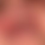 Differenzialdiagnose:&nbsp;Stevens-Johnson-Syndrom

Diagnose: Gingivostomatitis herpetica
