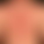 Differenzialdiagnose: Pustulose akute generalisierte exanthematische

Diagnose: Follikuläre Pustu...