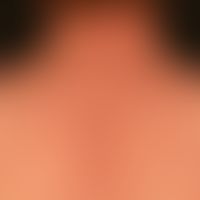 Differenzialdiagnose: Pustulose akute generalisierte exanthematische

Diagnose: Follikuläre Pustu...