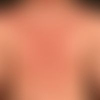 Differenzialdiagnose: Acne fulminans&nbsp;

Diagnose: Aknetypisch verteilte follikuläre Pustulose...