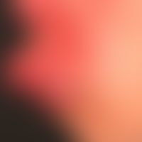 Melkersson-Rosenthal-Syndrom: monosymptomatische Verlaufsform mit schwerster, vollständig therapi...
