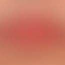 ​​​​​​Makrocheilie&nbsp;bei Cheilitis simplex

