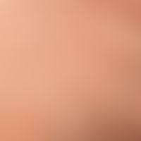 Differenzialdiagnose:&nbsp;Frontale fibrosierende Alopezie

Diagnose: Alopecia areata (Kadaverhaa...