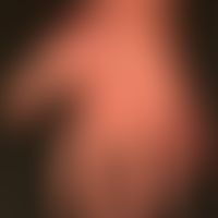 Psoriasis palmaris: trocken-keratotischer Plaque-Typ. Chronische flächige Hyperkeratosen .&nbsp;
