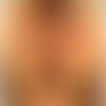 Transitorische akantholytische Dermatose: charakteristisches Verteilungsmuster bei M. Grover. Abb...