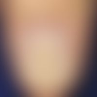 Waschbrettnägel: Tief eingezogene Querrillungen bei Habit-Tic Deformity.&nbsp;&nbsp;
