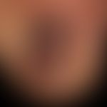 Akrolentiginöses Melanom mit streifiger Nagelpigmentierung
