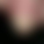 Pustulöse Onychodystrophie bei Acrodermatitis continua suppurativa Hallopeau
