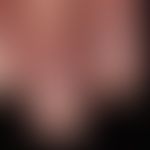 Meessche Querbänder:&nbsp;vorbekanntes Sézary-Syndrom. Deutliche weißliche Querbänderungen der Nä...