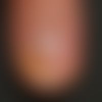 Psoriasis vulgaris chronisch-stationäre (Plaque-Typ):&nbsp;Ölfleck mit hyperämischen Randzone.&nb...
