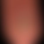 Onycholysis psoriatica: breite und tiefreichende&nbsp;Onycholyse mit zahlreichen Tüpfeln.&nbsp;

