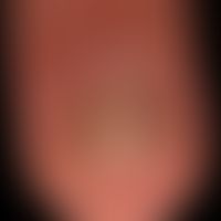 Onycholysis psoriatica: breite und tiefreichende&nbsp;Onycholyse mit zahlreichen Tüpfeln.&nbsp;
