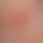 Gingivostomatitis herpetica: Herpesbläschen im Halsbereich
