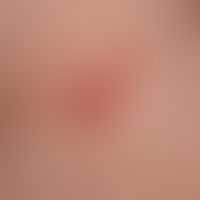 Gingivostomatitis herpetica: Herpesbläschen im Halsbereich
