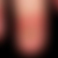 Psoriasis der Nägel:&nbsp;schwere nahzu komplette Zerstörung der Nagelplatte&nbsp;bei exusadative...
