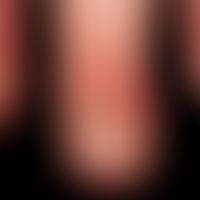 Psoriasis der Nägel: psoriatischer Befall von proximalem Nagelfalz kombiniert mit Ölfleck und dis...