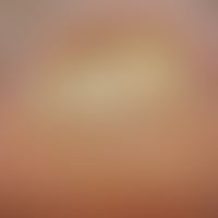 Psoriasis der Nägel:&nbsp;massive&nbsp;Onychogrypose bei bekannter Psoriasis. Abb. entnommen aus&...