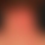 DD: Lichen simplex chronicus:&nbsp; juckende, unscharf begrenzte lichenifizierte Plaque mit rauer...