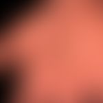 Teleangiektasie: multiple Teleangiektasien bei progressiver systemischer Sklerodermie

