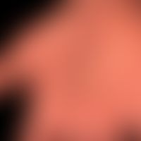 Teleangiektasie: multiple Teleangiektasien bei progressiver systemischer Sklerodermie
