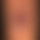 Riesenkeratoakanthom: klassisch gewachsenes riesenhaftes Keratoakanthom mit peripherer Lippenbild...