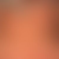 Hautalterung: Cutis rhomboidalis nuchae bei einm 75.-Jährigen.&nbsp;
