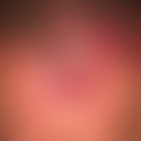 Primär kutanes B-Zell-Lymphom:&nbsp;Seit mehreren Monaten langsam wachsende, livid-rote, derbe&nb...