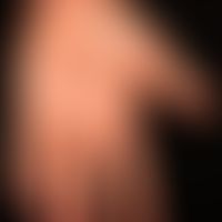 Lichen planus exanthematicus: bei bekanntem exanthematischen Lichen planus disseminierte Knötchen...