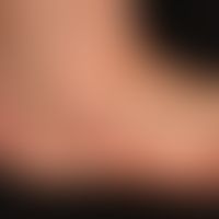 Lichen planus exanthematicus: seit 4-6&nbsp;Monaten persistierender, juckender, generalisierter, ...