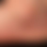 Lichen planus exanthematicus: seit 4-6&nbsp;Monaten persistierender, juckender, generalisierter, ...