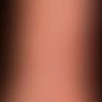Pemphigoid&nbsp;bullöses: multiple juckende Papeln und wenige Blasen. Teilsapekt eines generalisi...
