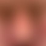 Pemphigoid bullöses: aufgeplatzte Blasen mit Blasenresten
