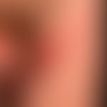 Pemphigoid bullöses:&nbsp;uncharakteristisches, vielgestaltiges klinisches Bild mit juckenden Ery...