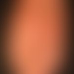 Pemphigoid bullöses: Blasen, Blasenreste, Erytheme; Ausschnitt bei generalisiertem Exanthem.
